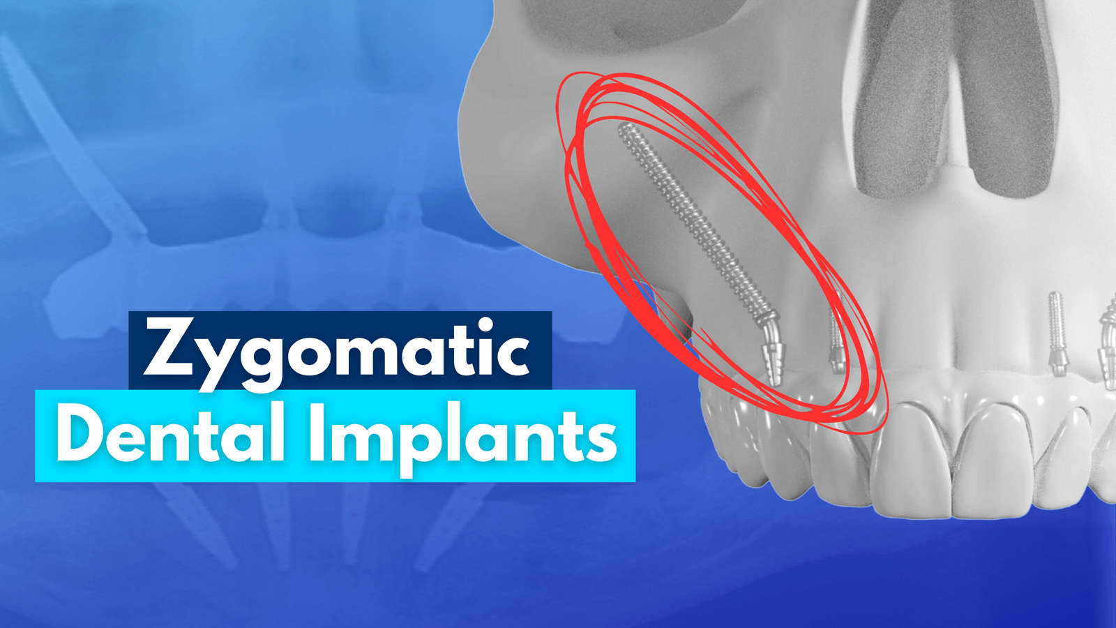 Everything You Need To Know About Zygomatic Dental Implants